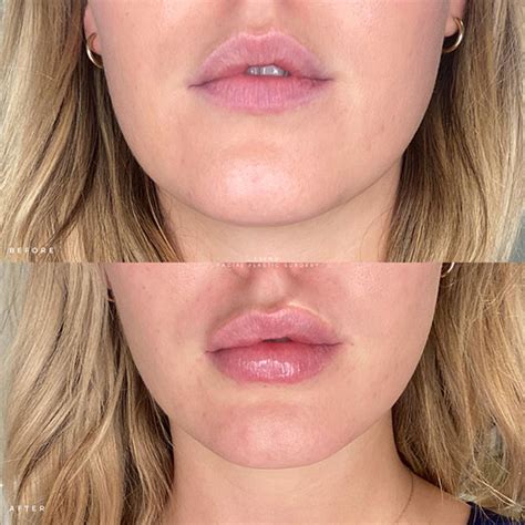 lip flip nyc|Lip Fillers in New York, NY 